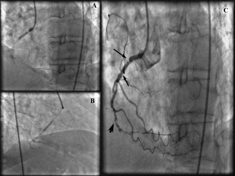 Severe accordion effect Myocardial ischemia due to wire complication