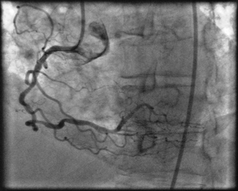Severe accordion effect Myocardial ischemia due to wire complication