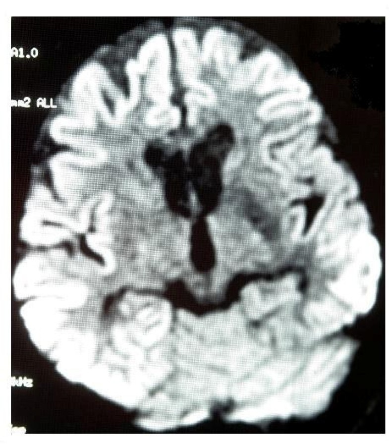 CreutzfeldtJacob Disease a case report Cases Journal Full Text