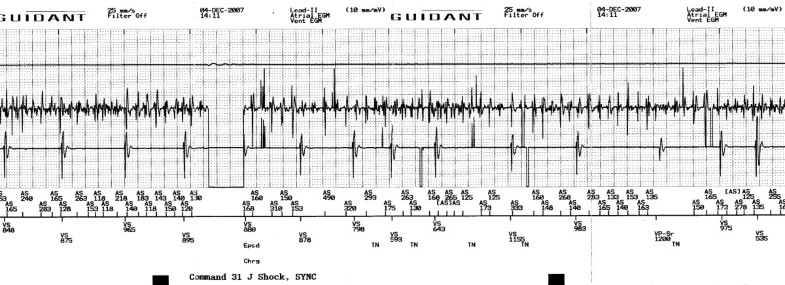 a fibrillation icd 10