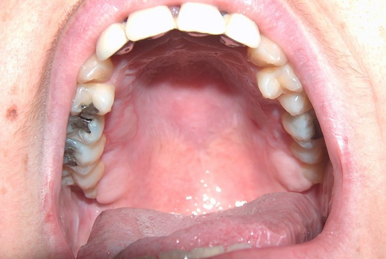 Thermal burn of palate caused by microwave heated cheesepie A case report Cases Journal