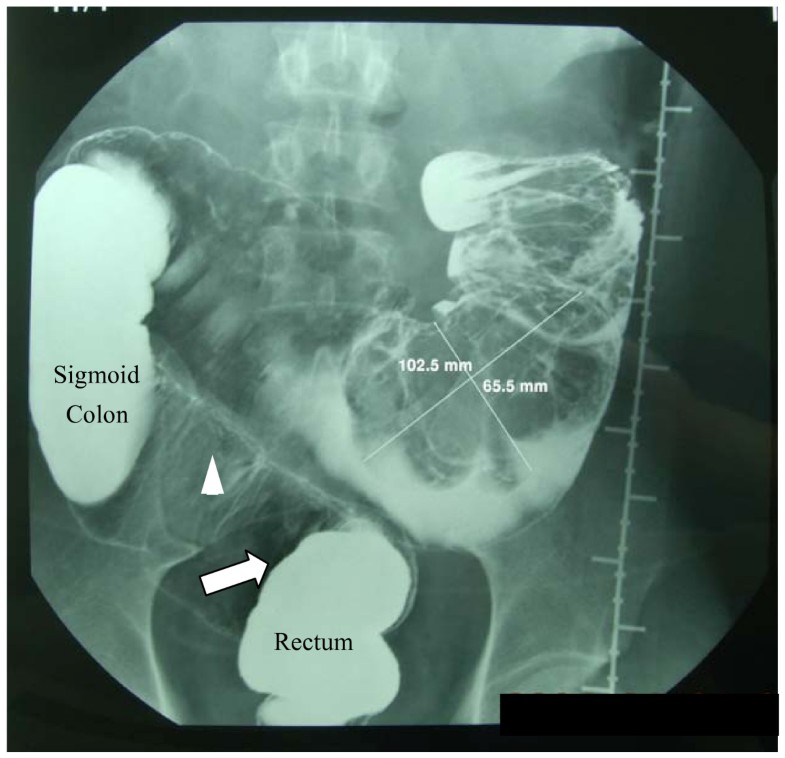 Severe adult ileosigmoid intussusception prolapsing from the rectum: A