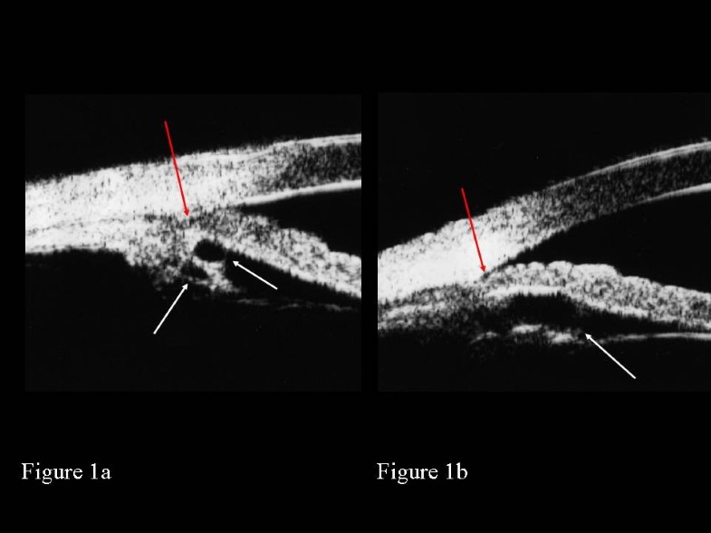 Argon laser peripheral iridoplasty for plateau iris associated with