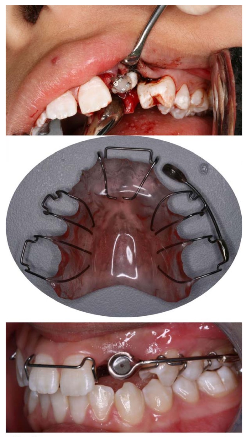 Orthodontic traction of impacted canine using a case report