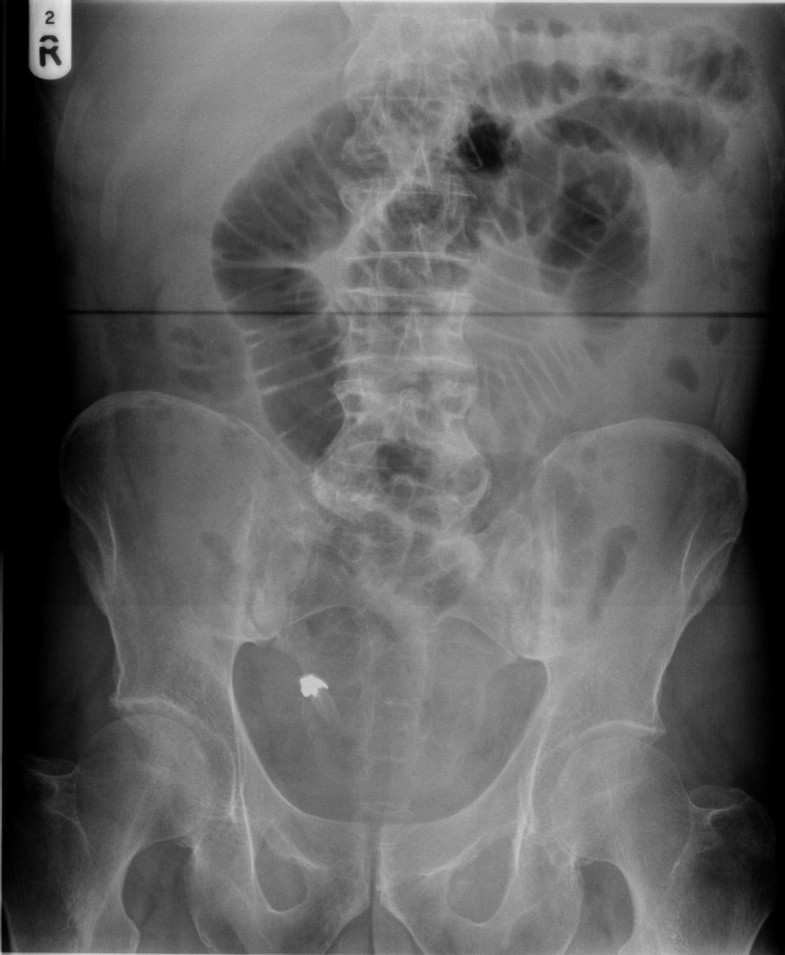 Swallowed dental bridge causing ileal perforation a case report