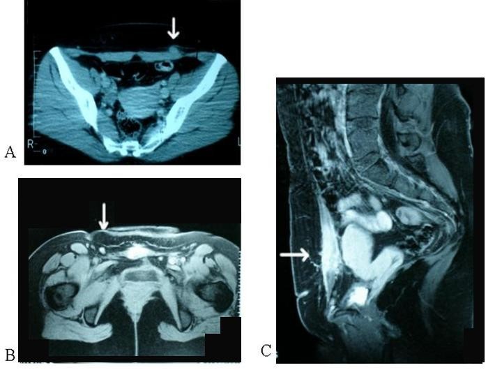 Ultrasound and MRimaging in preoperative evaluation of two rare cases