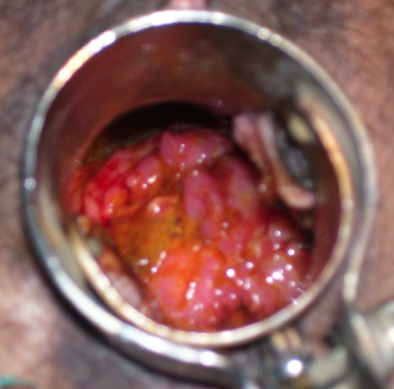 A rare case of cervical tuberculosis simulating carcinoma ... fallopian tubes diagram of woman 