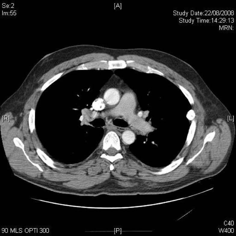 Glandular Fever And Pulmonary Artery Thrombosis In A Paraplegic Patient