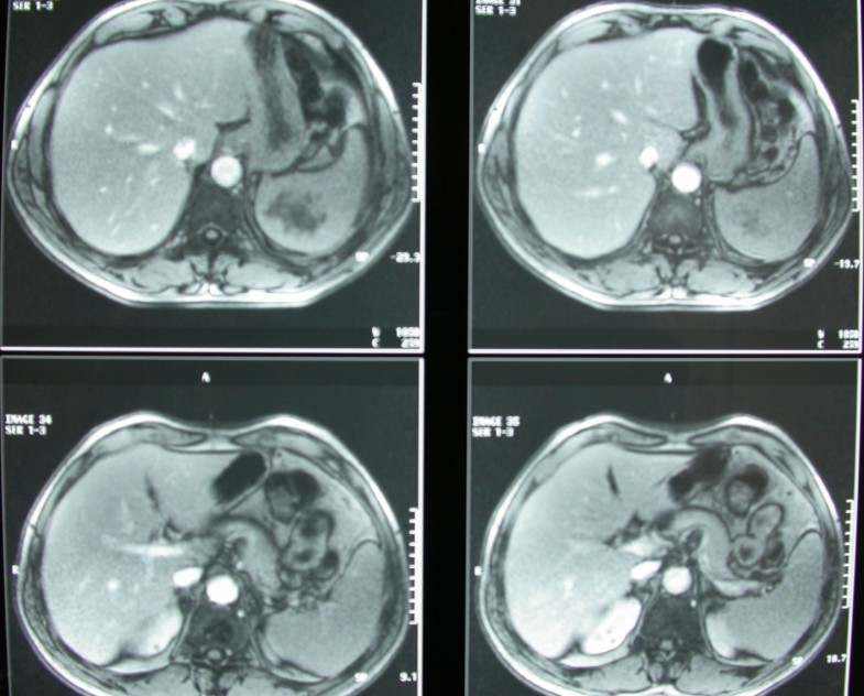 Solitary Splenic Metastasis Of Squamous Lung Cancer A Case Report Cases Journal Full Text