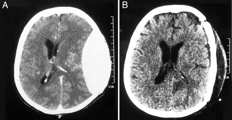 Primary plasmacytoma of the cranial vault: a case report | Cases ...