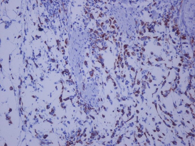 Urothelial carcinoma of the sarcomatoid variant in a young ...