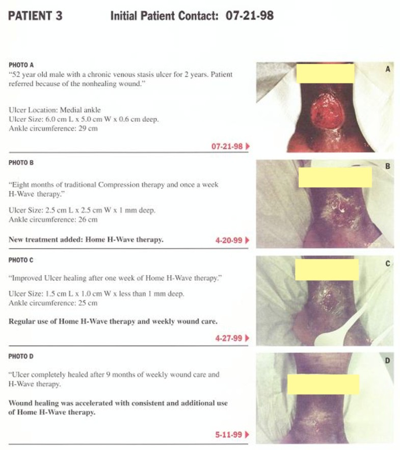 Healing enhancement of chronic venous stasis ulcers utilizing HWAVE®device therapy a case