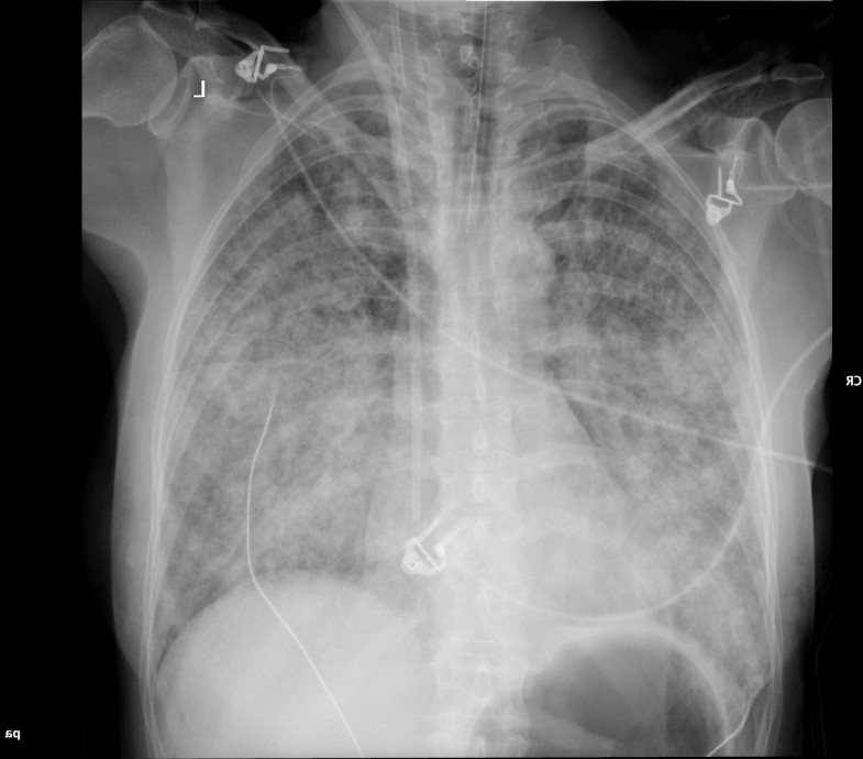 Resuscitation by hyperbaric exposure from a venous gas emboli following ...