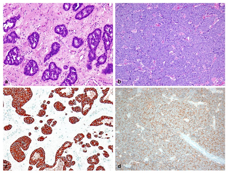 Sinonasal neuroendocrine carcinoma impact of