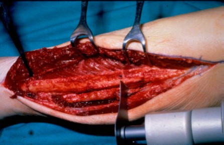 Analysis of the compatibility of dental implant systems in fibula free