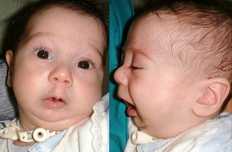 Mandibular distraction in neonates indications, technique, results