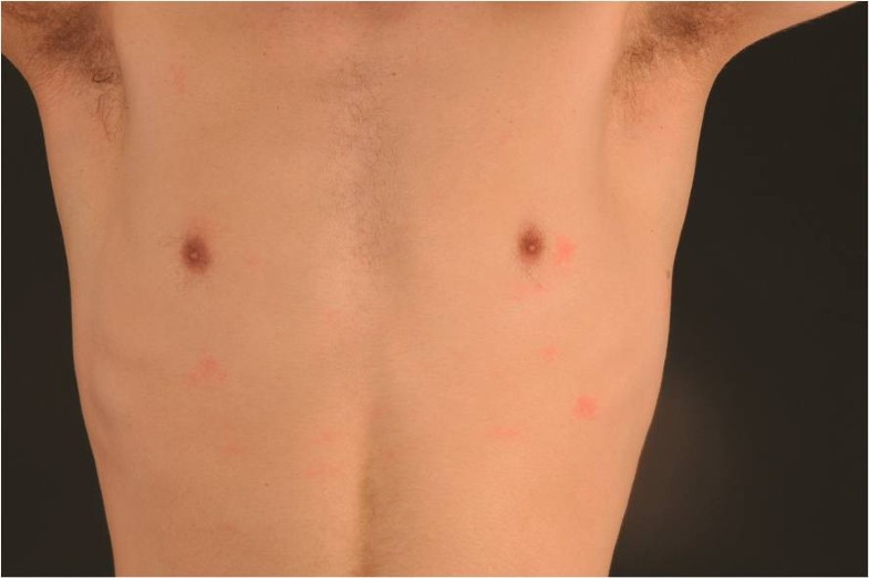 Aquagenic urticaria in twins World Allergy Organization Journal