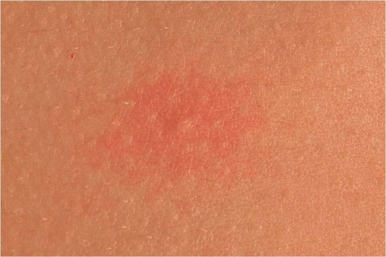 Aquagenic urticaria in twins World Allergy Organization Journal
