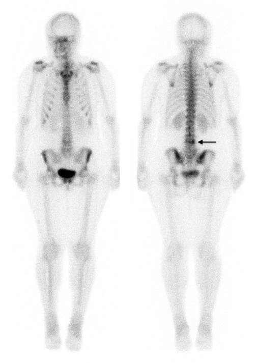 airo ct for lumbar spine