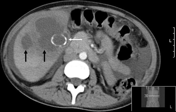 Intrahepatic Type Ii Gall Bladder Perforation By A Gall Stone In A Capd