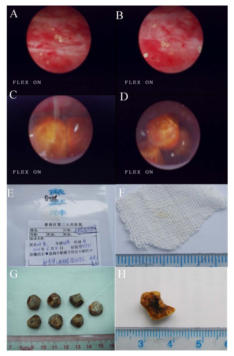 Tiny cystine stones in the gallbladder of a patient with
