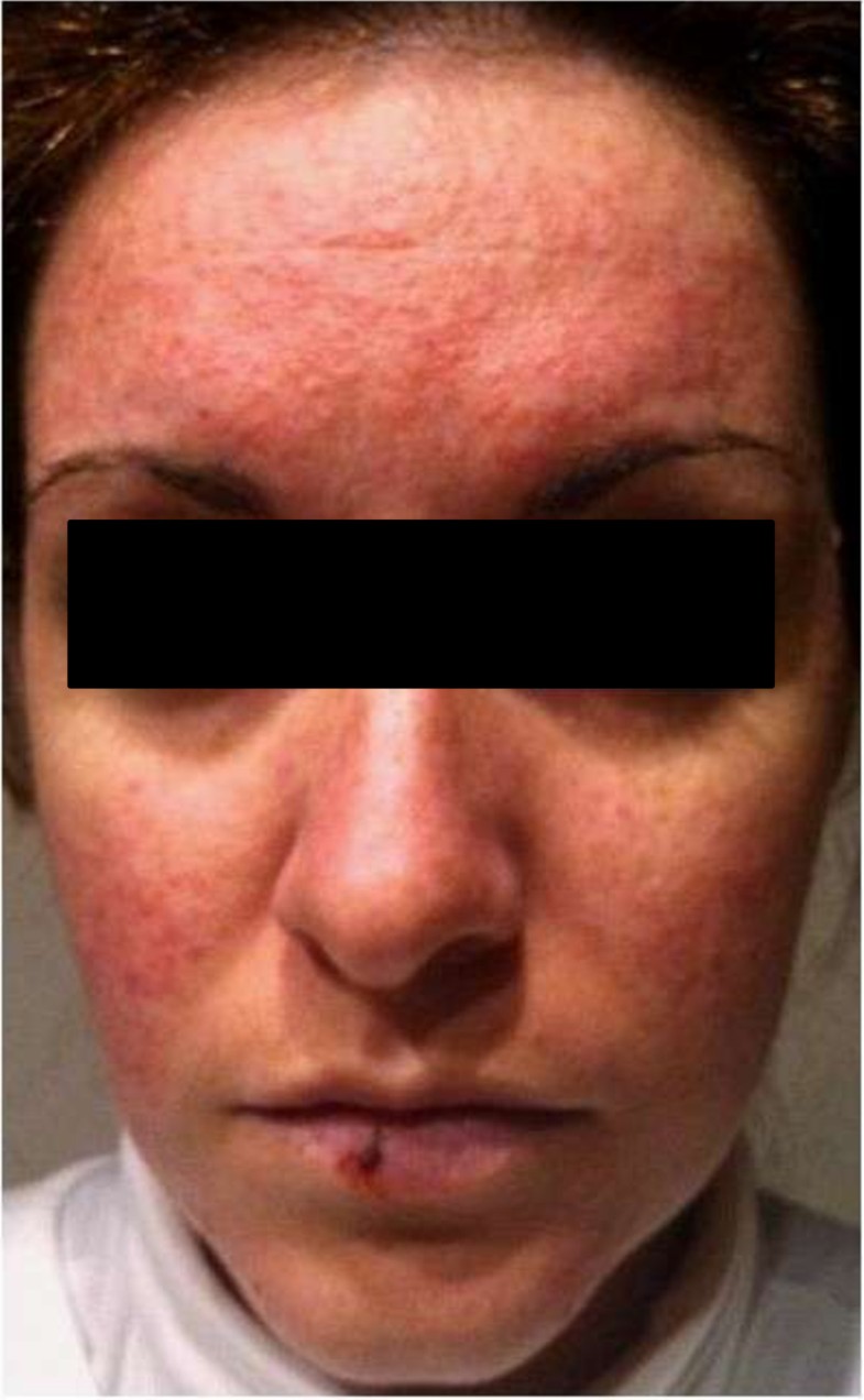 Rosacea-like facial rash related to metformin administration in a young ...