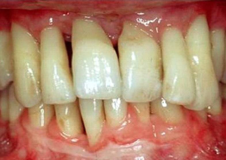 The association between rheumatoid arthritis and periodontal disease