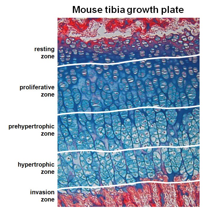 Hypertrophic differentiation of chondrocytes in osteoarthritis the