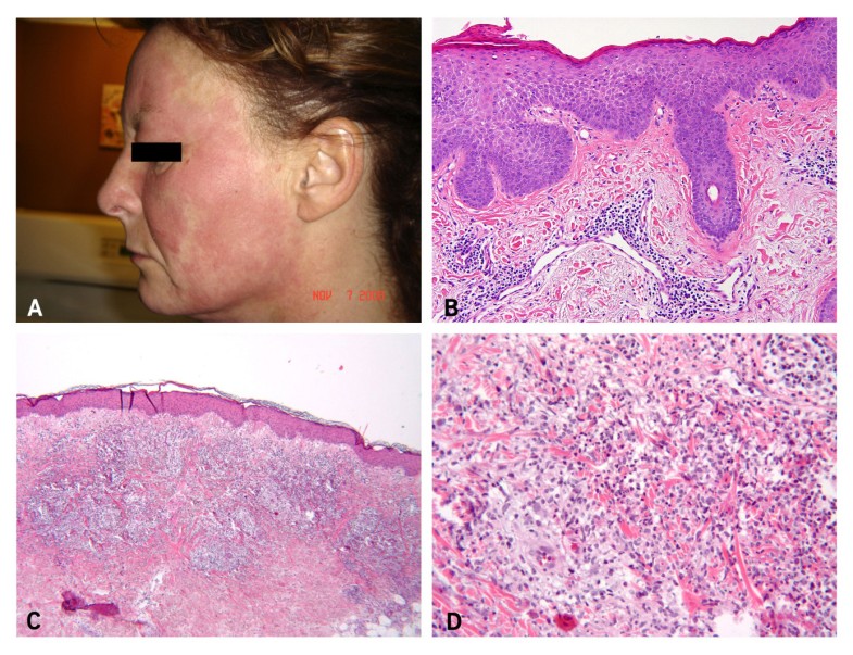 A new category of autoinflammatory disease associated with NOD2 gene ...