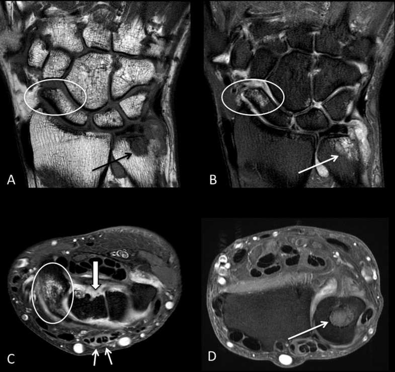 Bone marrow edema and osteitis in rheumatoid arthritis the imaging