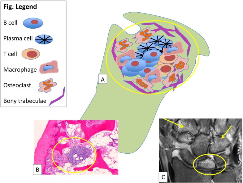 Bone marrow edema and osteitis in rheumatoid arthritis the imaging