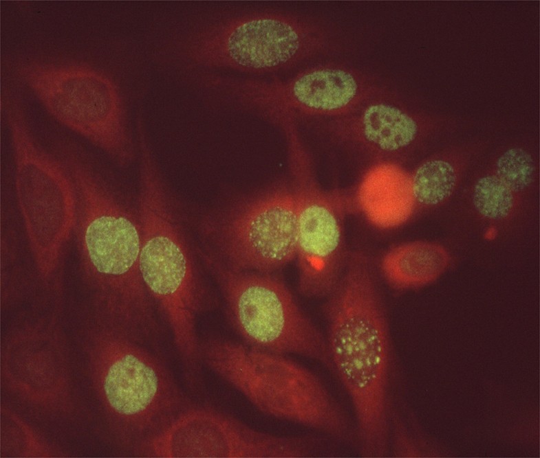 Antinuclear antibodies defining autoimmunity pathways Arthritis