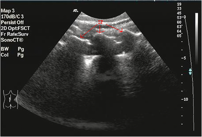 Ultrasoundguided versus low dose computed tomography scanning guidance