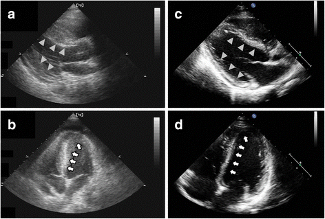 Dramatic and early response to low-dose steroid in the treatment of acute eosinophilic ...