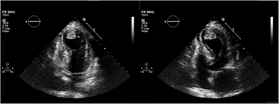 Takotsubo cardiomyopathy complicated with apical thrombus formation on first day of the illness ...