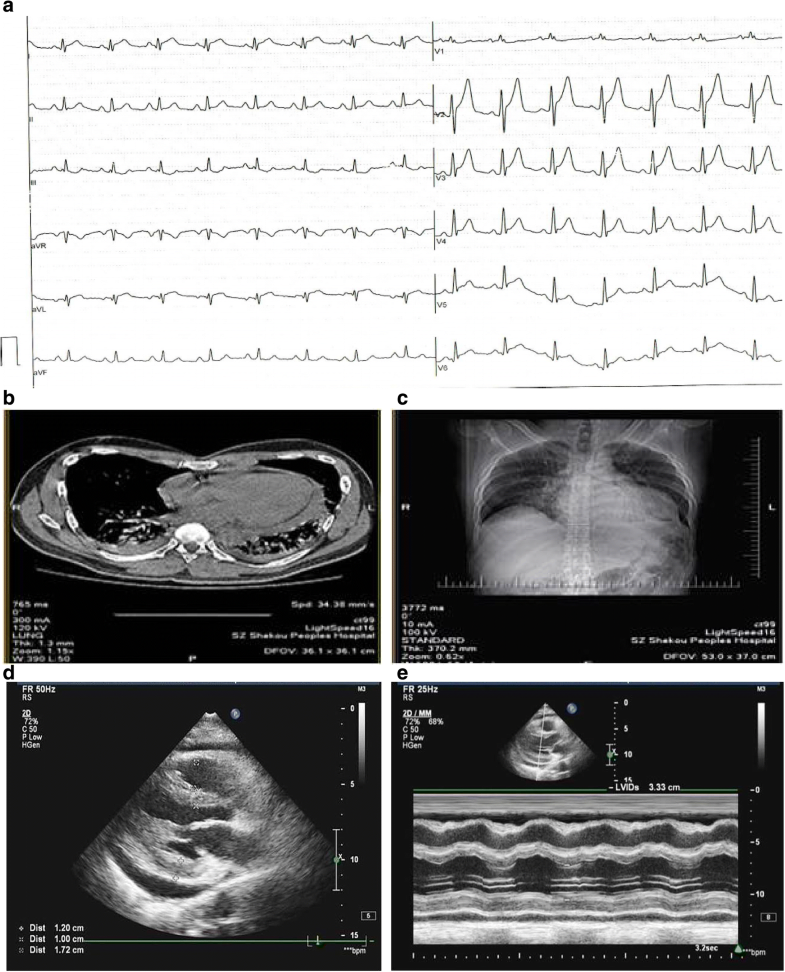 Postcardiac injury syndrome in acute myocardial infarction patients