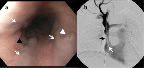 Bleeding ‘downhill’ esophageal varices associated with benign superior