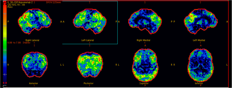 FDG-PET in suspected dementia with Lewy bodies: a case report | BMC ...