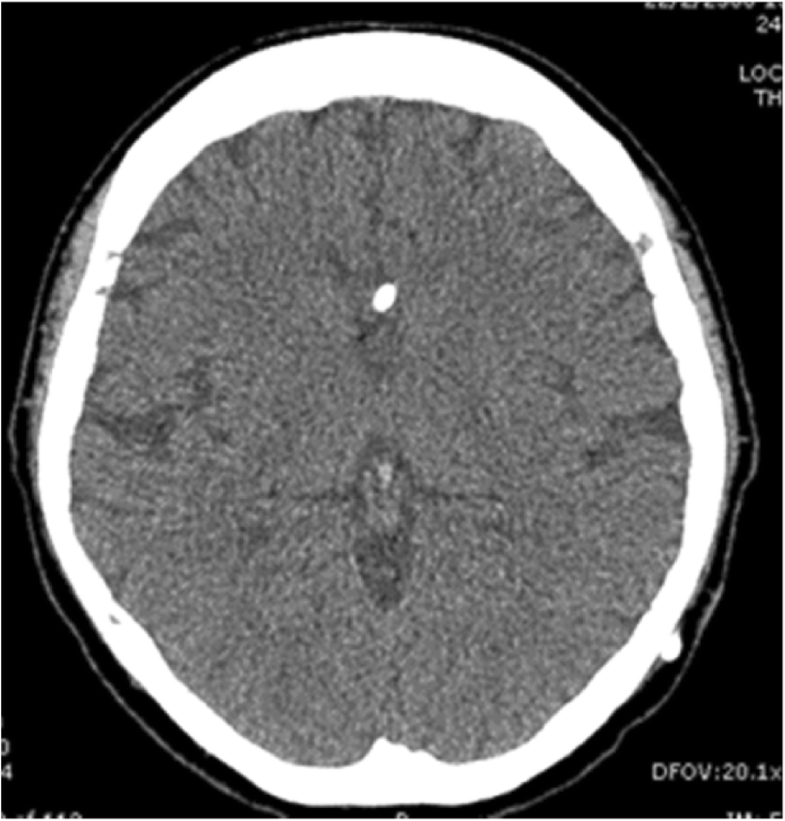 Undiagnosed Cryptococcus gattii meningitis leading to subsequent