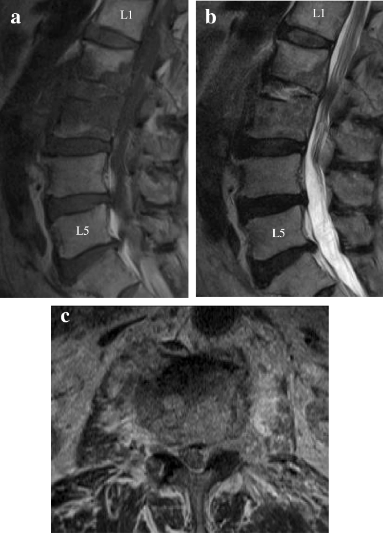 Bacille Calmette-Guérin (BCG) spondylitis with adjacent mycotic aortic ...