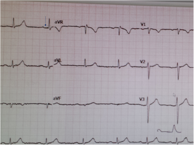 First case report of inducible heart block in Lyme disease and an