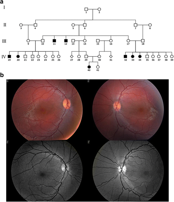 Novel GUCY2D mutation causes phenotypic variability of Leber congenital amaurosis in a large