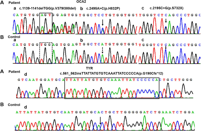 analyses of oculocutaneous albinism types 1 and 2 with four