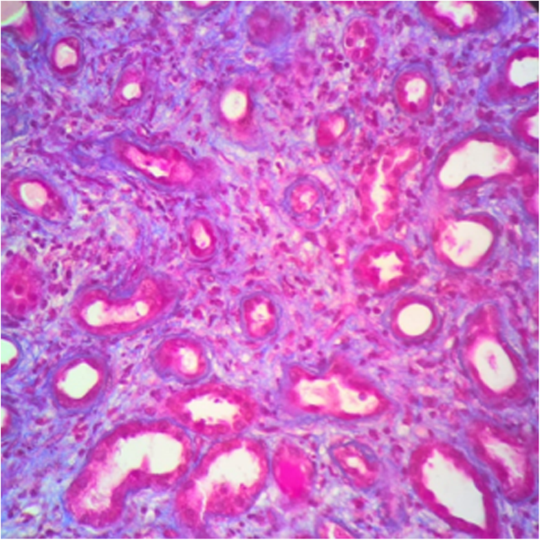 Spectrum of acute kidney injury associated with cocaine use report of
