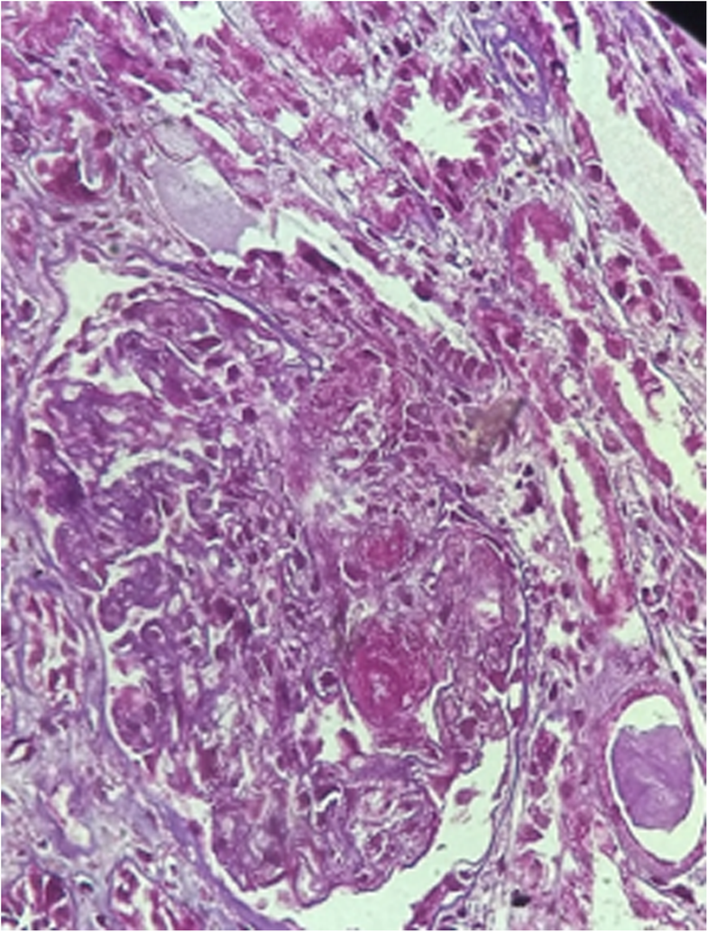 Spectrum of acute kidney injury associated with cocaine use report of