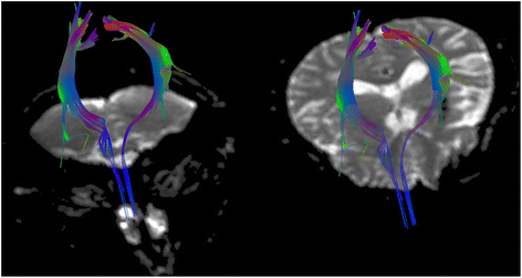 tensor diffusion hemiparesis corticospinal tractography uncrossed palsy gaze tracts ipsilateral scoliosis putaminal hemorrhage