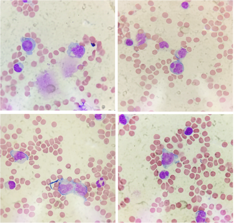 Diagnosis of central nervous system lymphoma via cerebrospinal fluid ...