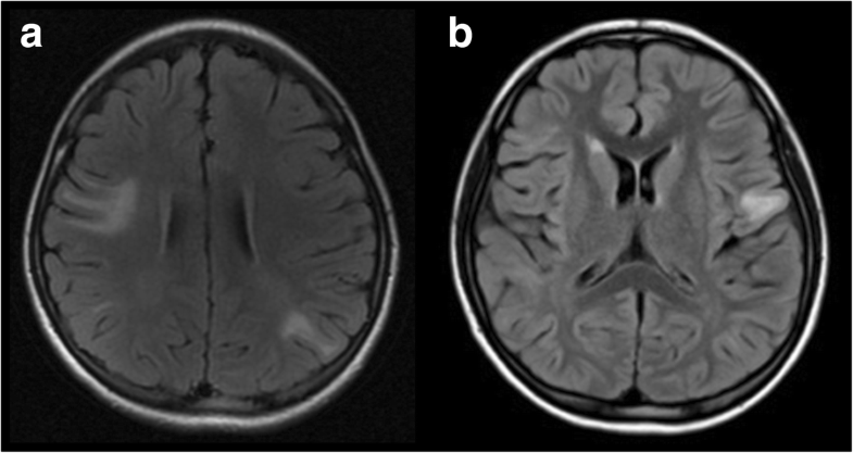 mog optic neuritis