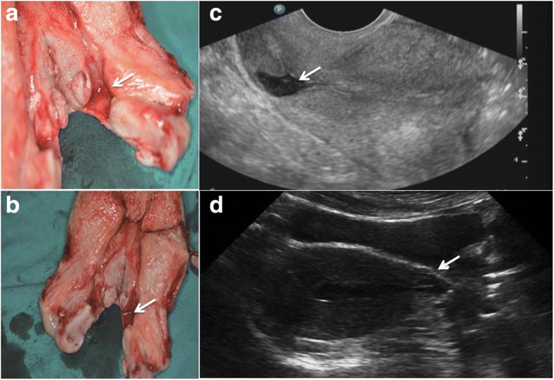 Obstetrical after vaginal repair of caesarean scar diverticula in reproductiveaged