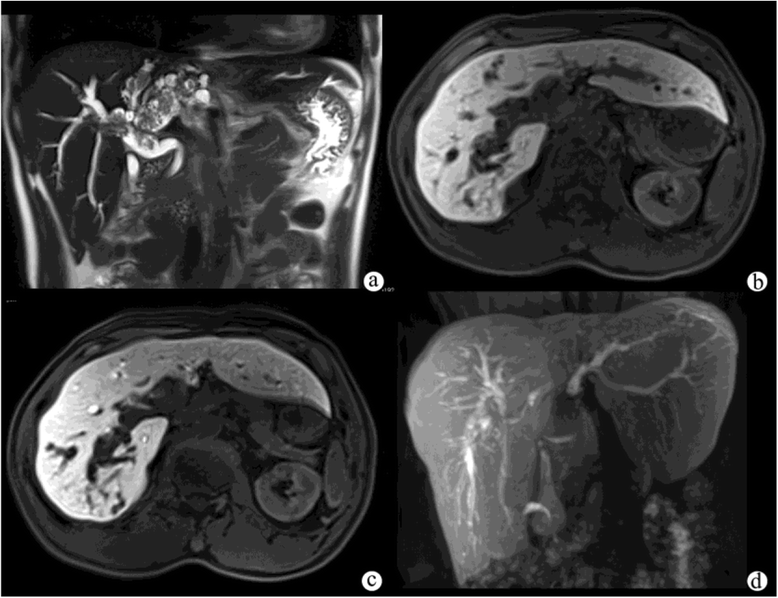 Cholangiocarcinoma spectrum of appearances on GdEOBDTPAenhanced MR